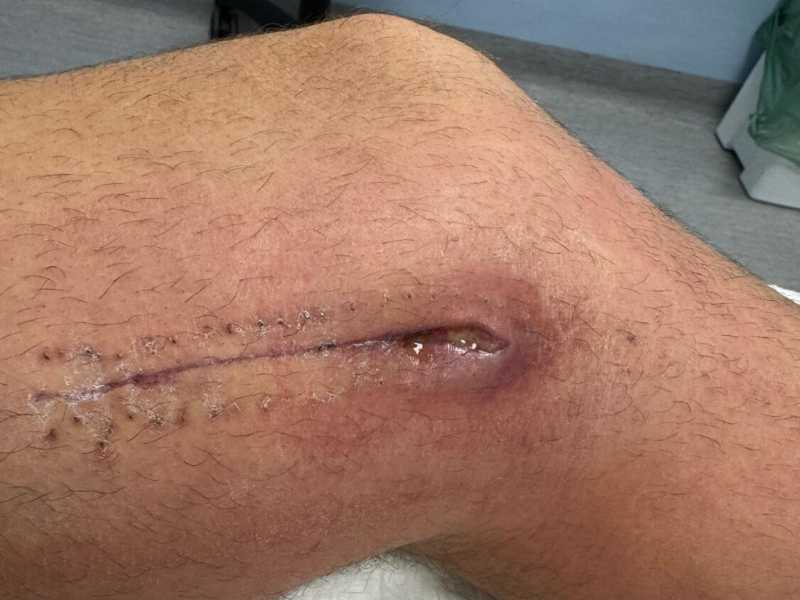 Alberto Durán ha vuelto a ser ingresado de urgencia